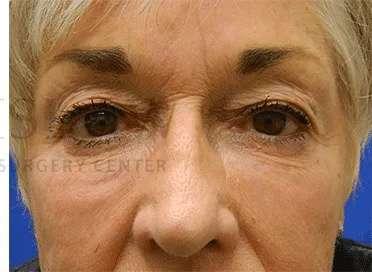 Facelift after at Facelift Conneticut: Dr. Paul Stanislaw in Avon, CT