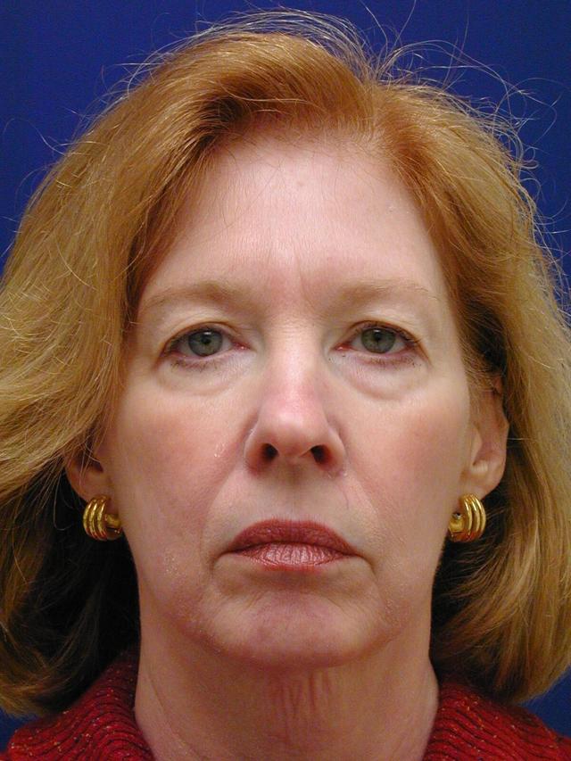Facelift before at Facelift Conneticut: Dr. Paul Stanislaw in Avon, CT