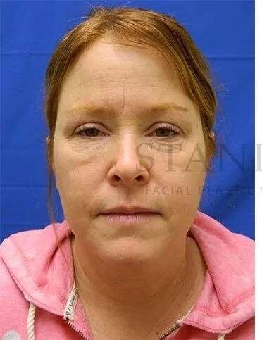 Chemical Peel before at Facelift Conneticut: Dr. Paul Stanislaw in Avon, CT
