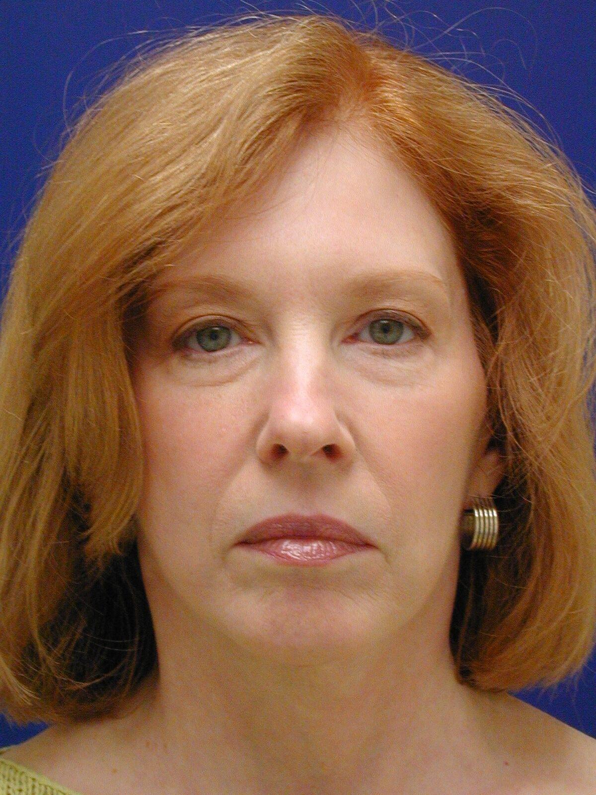 Facelift Conneticut: Dr. Paul Stanislaw facelift after — Avon, CT