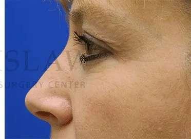 Facelift Conneticut: Dr. Paul Stanislaw facelift after — Avon, CT