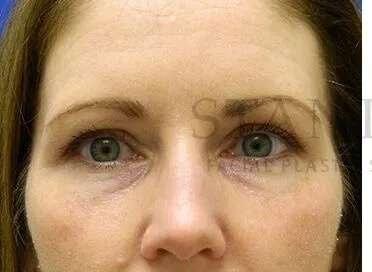 Lip Filler before at Facelift Conneticut: Dr. Paul Stanislaw in Avon, CT
