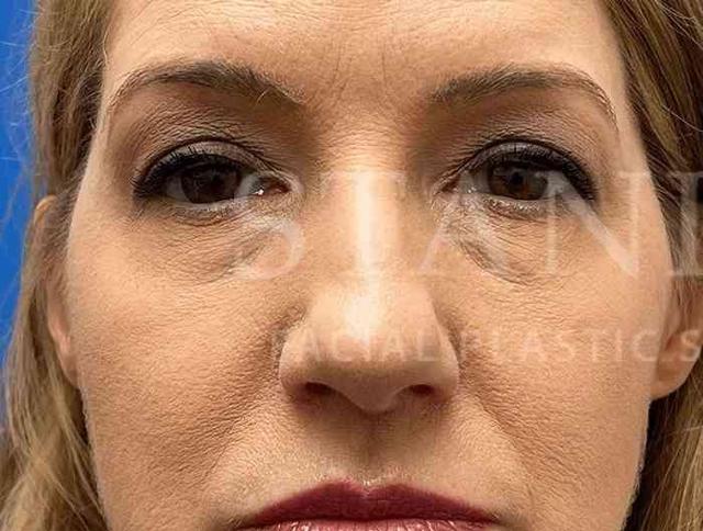 Blepharoplasty before at Facelift Conneticut: Dr. Paul Stanislaw in Avon, CT