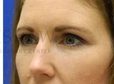 Lip Filler after at Facelift Conneticut: Dr. Paul Stanislaw in Avon, CT