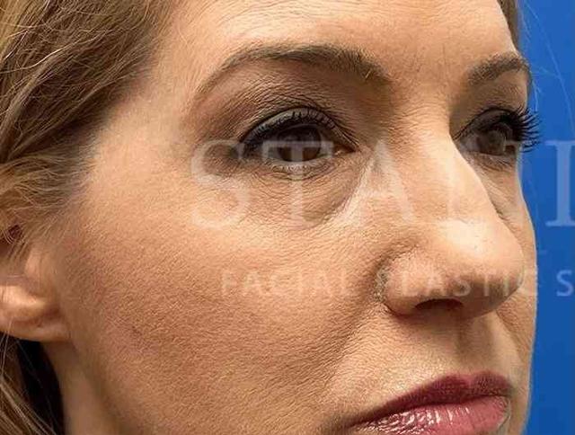 Blepharoplasty before at Facelift Conneticut: Dr. Paul Stanislaw in Avon, CT