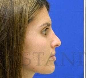 Rhinoplasty before at Facelift Conneticut: Dr. Paul Stanislaw in Avon, CT