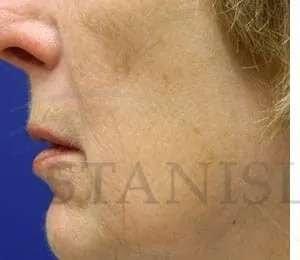 Chemical Peel before at Facelift Conneticut: Dr. Paul Stanislaw in Avon, CT