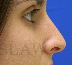 Rhinoplasty after at Facelift Conneticut: Dr. Paul Stanislaw in Avon, CT