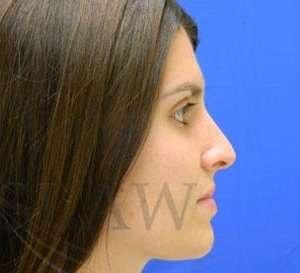 Rhinoplasty after at Facelift Conneticut: Dr. Paul Stanislaw in Avon, CT