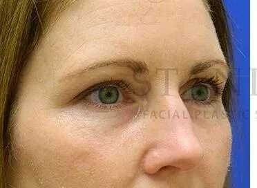Lip Filler before at Facelift Conneticut: Dr. Paul Stanislaw in Avon, CT
