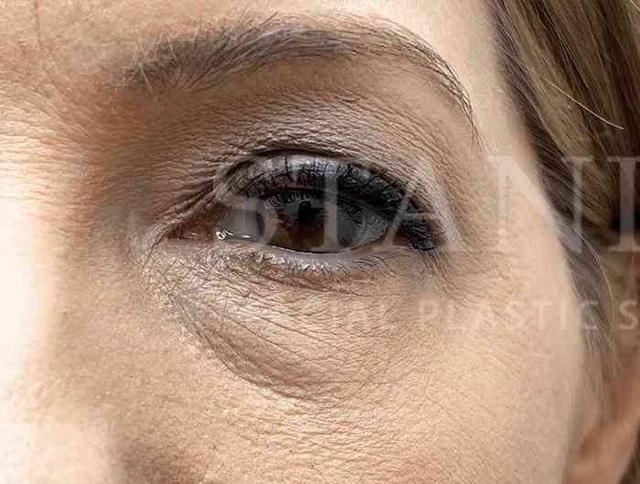 Blepharoplasty before at Facelift Conneticut: Dr. Paul Stanislaw in Avon, CT