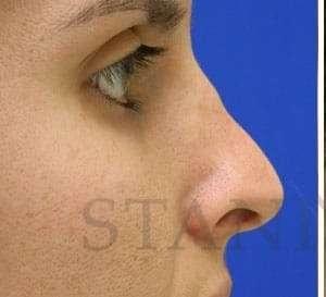 Rhinoplasty before at Facelift Conneticut: Dr. Paul Stanislaw in Avon, CT