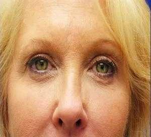 Facelift after at Facelift Conneticut: Dr. Paul Stanislaw in Avon, CT