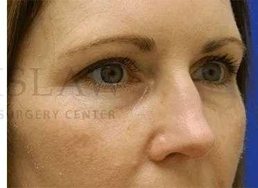 Facelift Conneticut: Dr. Paul Stanislaw facelift after — Avon, CT