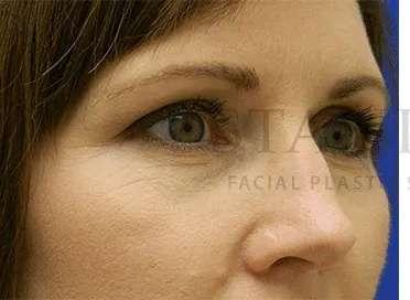 Facelift before at Facelift Conneticut: Dr. Paul Stanislaw in Avon, CT