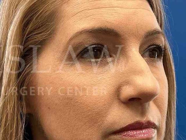 Blepharoplasty after at Facelift Conneticut: Dr. Paul Stanislaw in Avon, CT