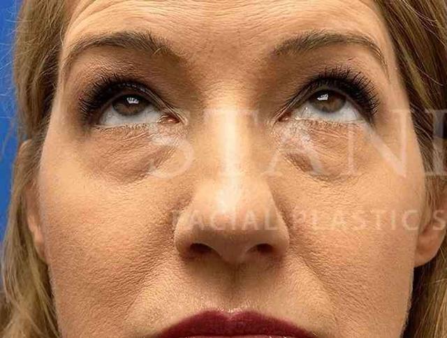 Blepharoplasty before at Facelift Conneticut: Dr. Paul Stanislaw in Avon, CT