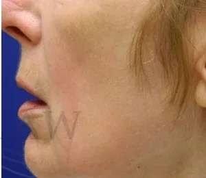 Chemical Peel after at Facelift Conneticut: Dr. Paul Stanislaw in Avon, CT