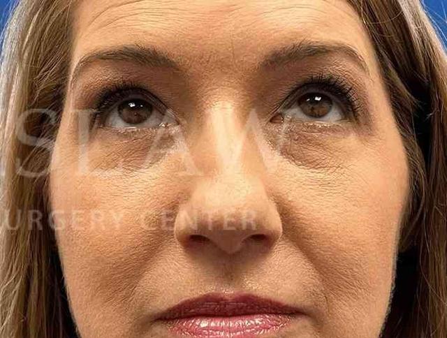Blepharoplasty after at Facelift Conneticut: Dr. Paul Stanislaw in Avon, CT