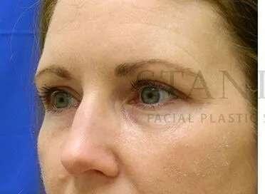 Lip Filler before at Facelift Conneticut: Dr. Paul Stanislaw in Avon, CT
