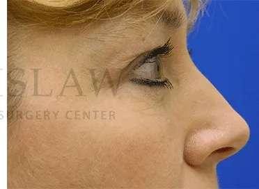 Facelift after at Facelift Conneticut: Dr. Paul Stanislaw in Avon, CT