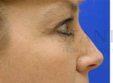 Facelift before at Facelift Conneticut: Dr. Paul Stanislaw in Avon, CT