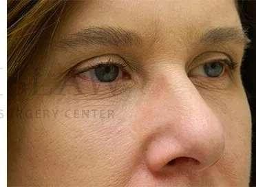Lip Filler after at Facelift Conneticut: Dr. Paul Stanislaw in Avon, CT