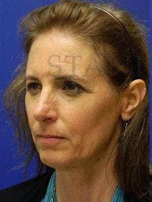 Brow Lift before at Facelift Conneticut: Dr. Paul Stanislaw in Avon, CT