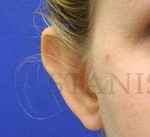 Facelift before at Facelift Conneticut: Dr. Paul Stanislaw in Avon, CT
