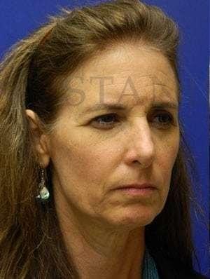 Brow Lift before at Facelift Conneticut: Dr. Paul Stanislaw in Avon, CT