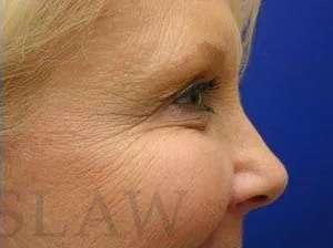 Facelift after at Facelift Conneticut: Dr. Paul Stanislaw in Avon, CT