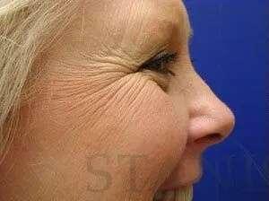 Facelift before at Facelift Conneticut: Dr. Paul Stanislaw in Avon, CT