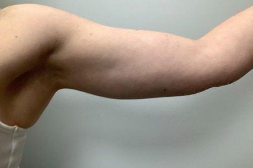 Liposuction after at Boulder Valley Plastic Surgery in Boulder, CO