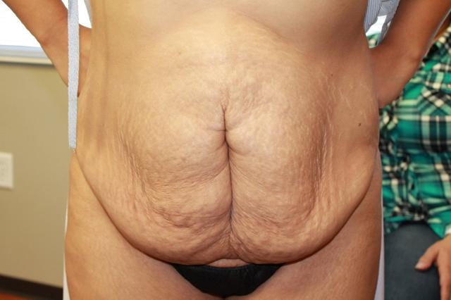 Tummy Tuck before at Boulder Valley Plastic Surgery in Boulder, CO