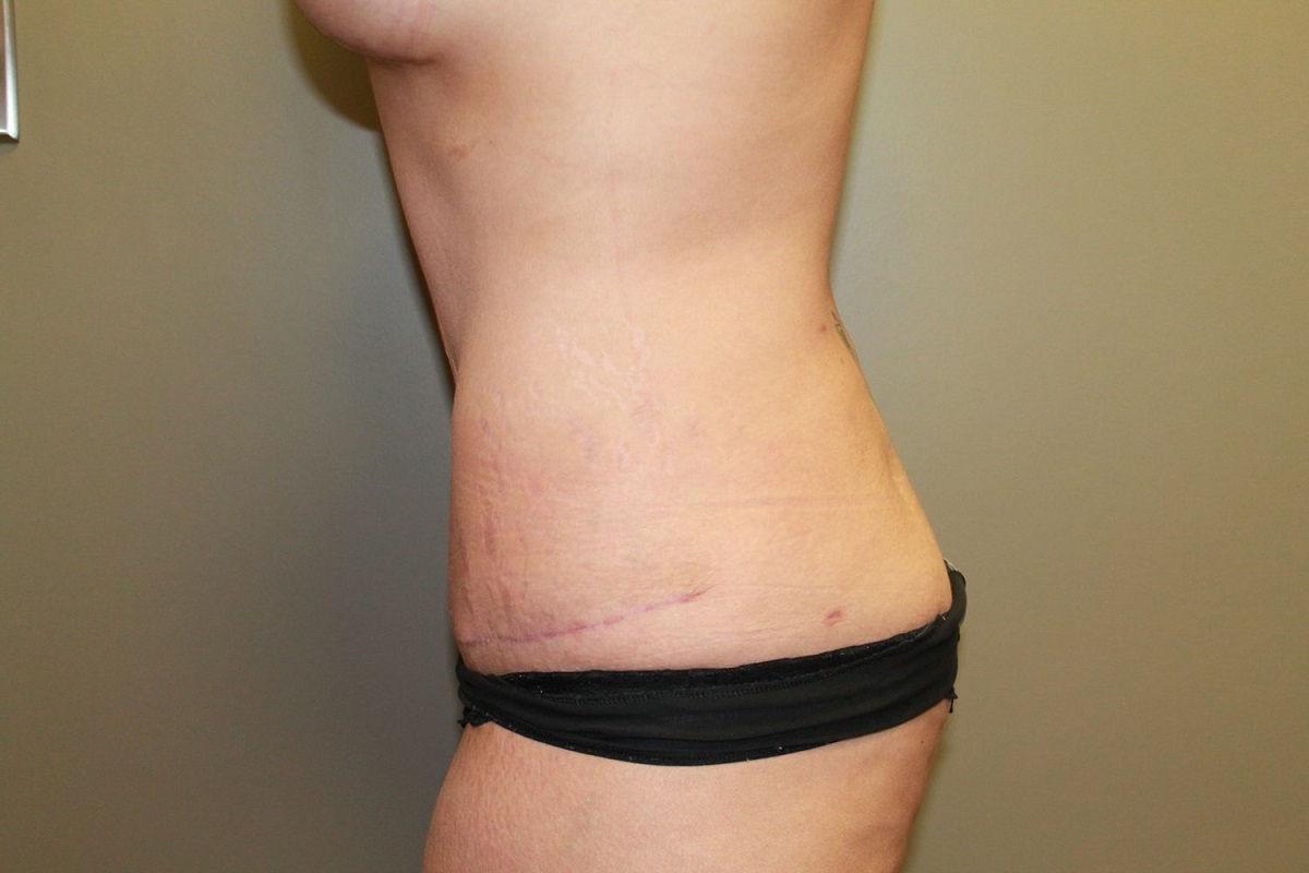 Boulder Valley Plastic Surgery tummy tuck after — Boulder, CO