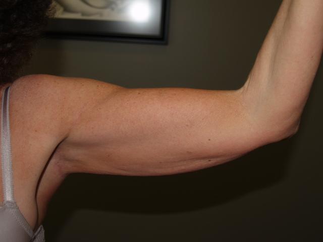 Arm Lift after at Boulder Valley Plastic Surgery in Boulder, CO