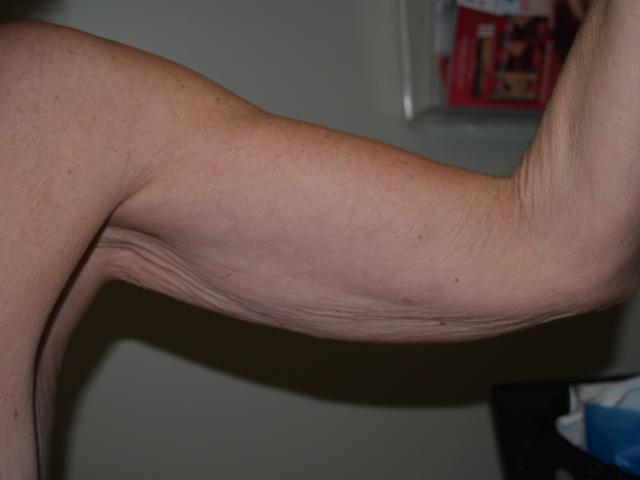 Arm Lift before at Boulder Valley Plastic Surgery in Boulder, CO