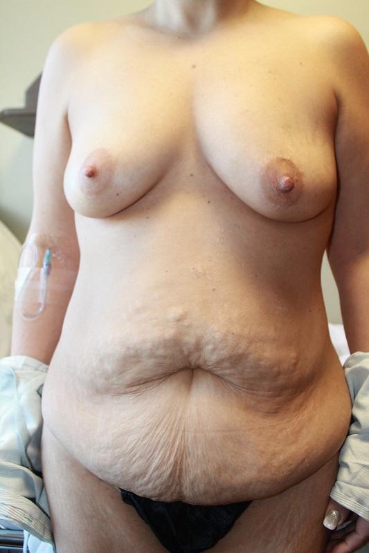 Mommy Makeover before at Boulder Valley Plastic Surgery in Boulder, CO