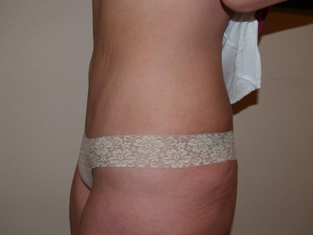 Boulder Valley Plastic Surgery tummy tuck after — Boulder, CO