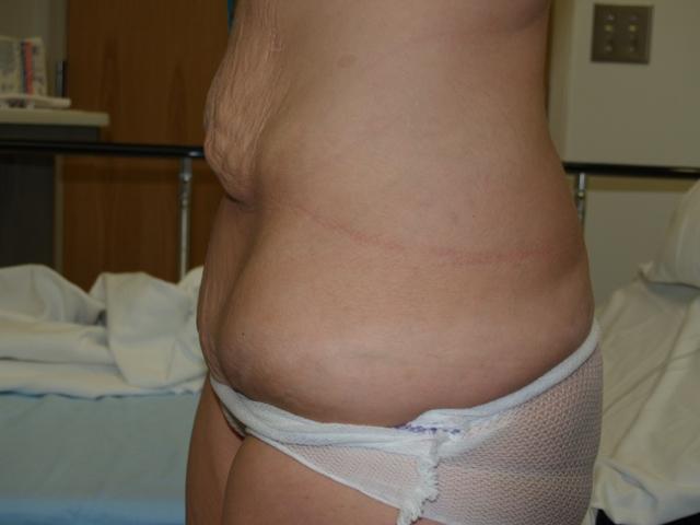 Tummy Tuck before at Boulder Valley Plastic Surgery in Boulder, CO