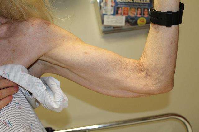 Arm Lift before at Boulder Valley Plastic Surgery in Boulder, CO