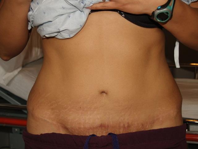 Tummy Tuck after at Boulder Valley Plastic Surgery in Boulder, CO