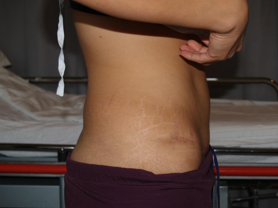 Boulder Valley Plastic Surgery tummy tuck after — Boulder, CO