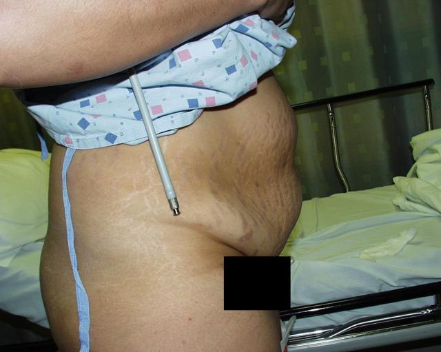 Tummy Tuck before at Boulder Valley Plastic Surgery in Boulder, CO
