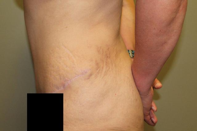 Tummy Tuck after at Boulder Valley Plastic Surgery in Boulder, CO