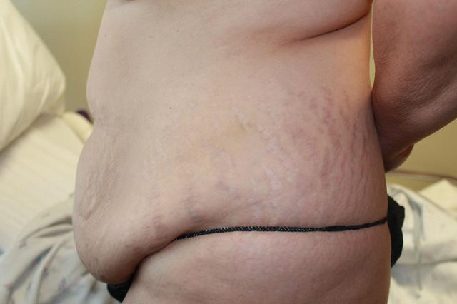 Tummy Tuck before at Boulder Valley Plastic Surgery in Boulder, CO