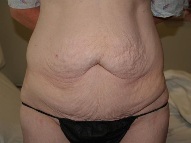 Tummy Tuck before at Boulder Valley Plastic Surgery in Boulder, CO