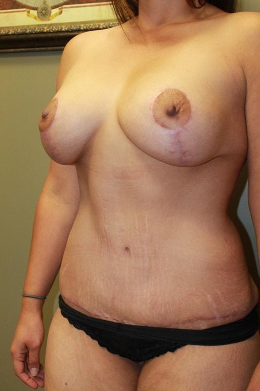 Mommy Makeover after at Boulder Valley Plastic Surgery in Boulder, CO