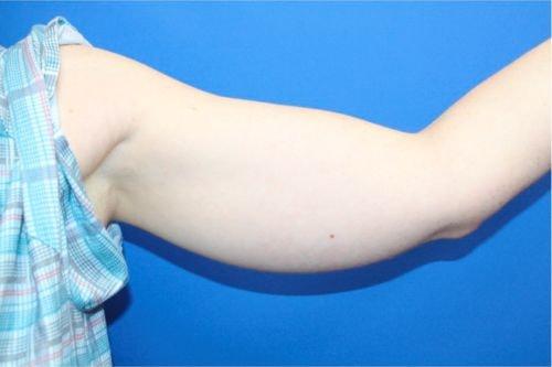 Liposuction before at Boulder Valley Plastic Surgery in Boulder, CO