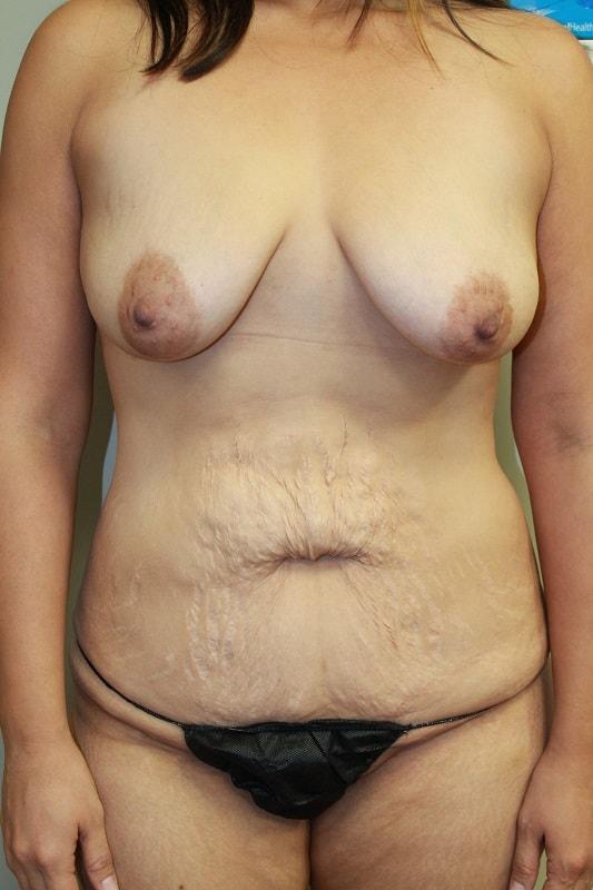 Mommy Makeover before at Boulder Valley Plastic Surgery in Boulder, CO
